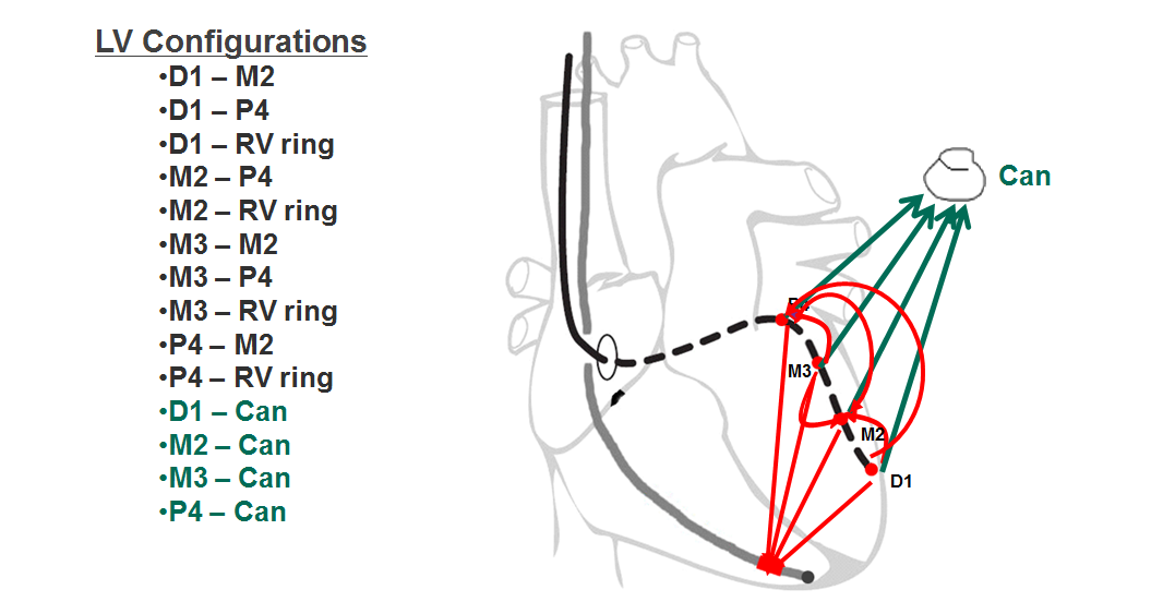 Saint Jude Medical LV Pacing | Cardiocases