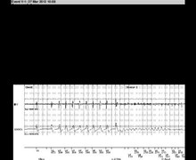induction of VF with flawed detecting causing shock diversion