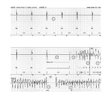 Induction of ventricular fibrillation in presence of high defibrillation threshold