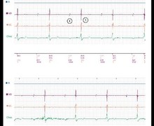 Loss of biventricular capture