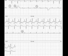 AdaptivCRT programming in a patient with a normal PR interval