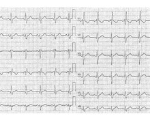 Syncopes in a patient with right bundle branch block and left anterior fascicular block