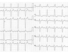 Syncope, left bundle branch block and second-degree atrioventricular block type 1