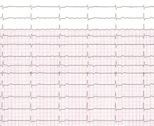 Atrial flutter and atrioventricular conduction disorder