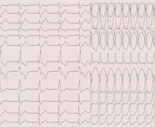 Tachycardie ventriculaire chez un patient avec tétralogie de Fallot