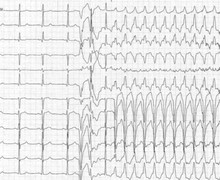 Atypical atrio-ventricular nodal reentrant tachycardia