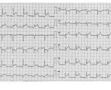 Chest pain, ST-segment elevation and acute pericarditis