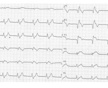 Anterior infarction with appearance of right bundle branch block