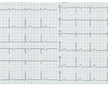 Normal ventricular activation and QRS-complex duration
