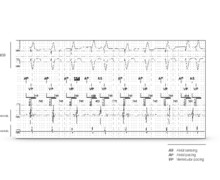loss of atrial capture 