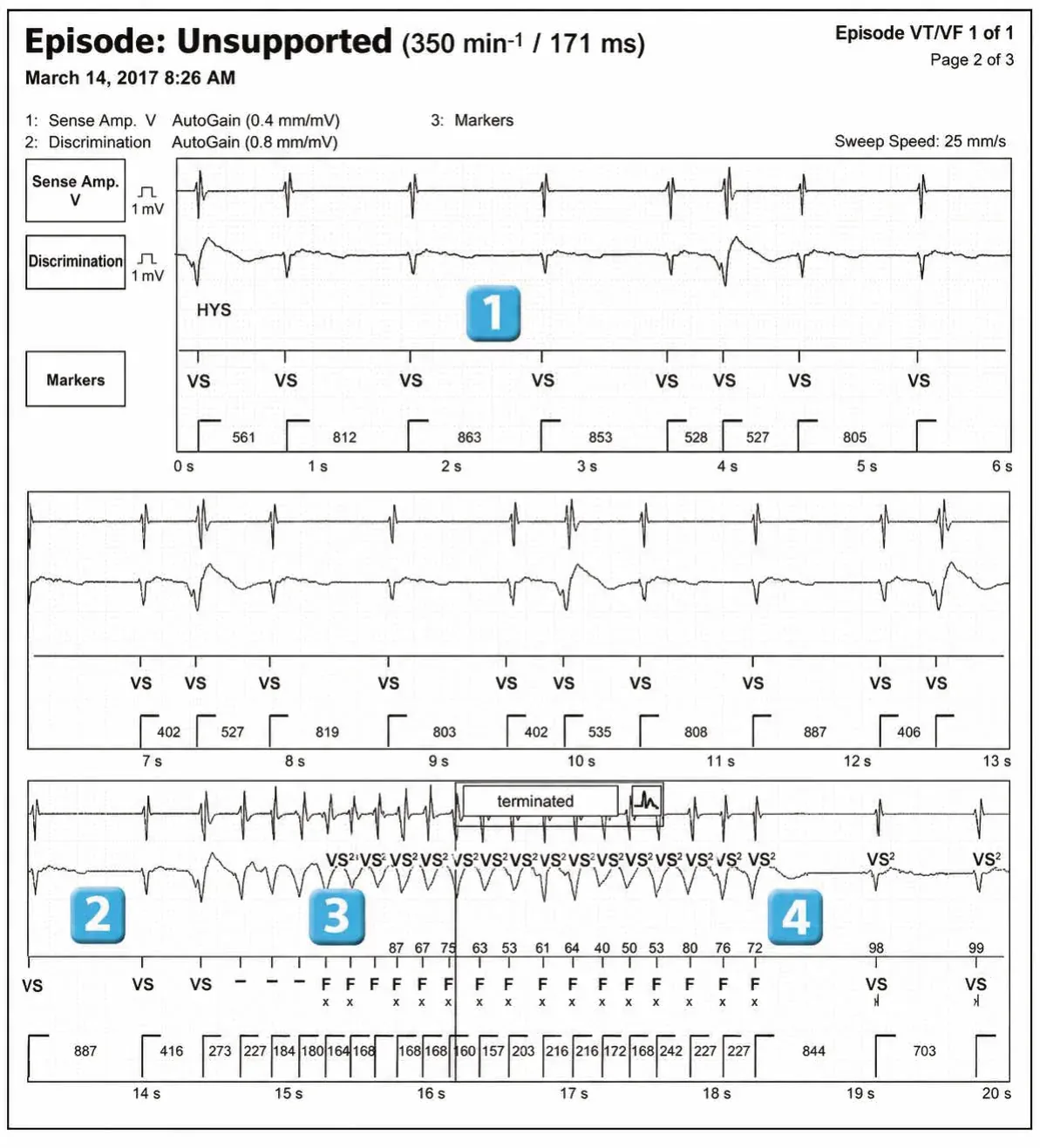 Abbott ICD electrogram, segment 1 of 1 — Classification of cycles, tachycardia counters and evolution of guideline recommendations