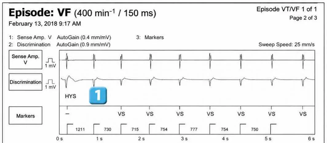 Abbott ICD electrogram, segment 1 of 4 — Classification of cycles, tachycardia counters and evolution of guideline recommendations