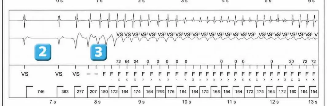 Abbott ICD electrogram, segment 2 of 4 — Classification of cycles, tachycardia counters and evolution of guideline recommendations