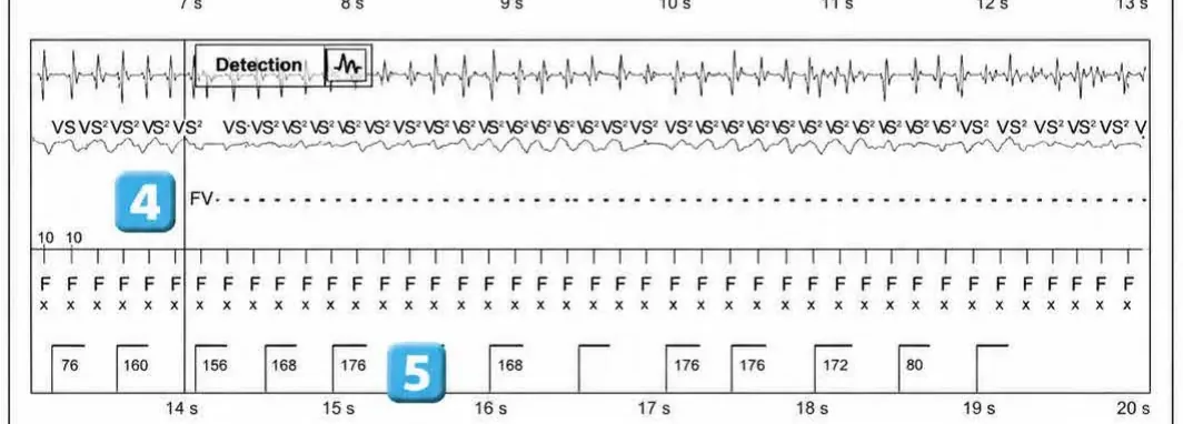 Abbott ICD electrogram, segment 3 of 4 — Classification of cycles, tachycardia counters and evolution of guideline recommendations