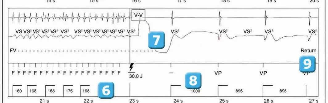 Abbott ICD electrogram, segment 4 of 4 — Classification of cycles, tachycardia counters and evolution of guideline recommendations