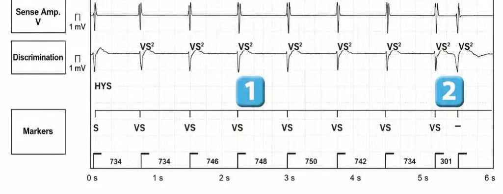 Abbott ICD electrogram, segment 1 of 3 — Classification of cycles, tachycardia counters and evolution of guideline recommendations