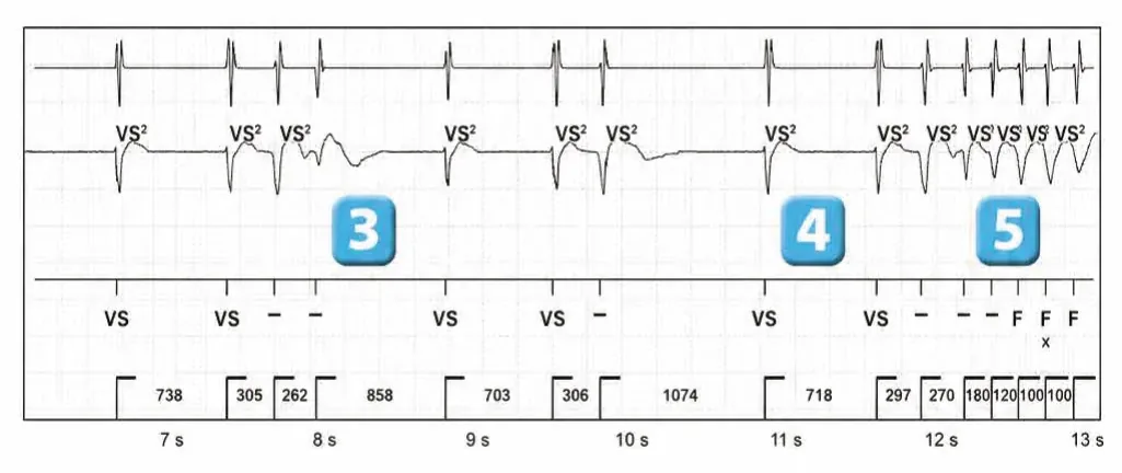 Abbott ICD electrogram, segment 2 of 3 — Classification of cycles, tachycardia counters and evolution of guideline recommendations