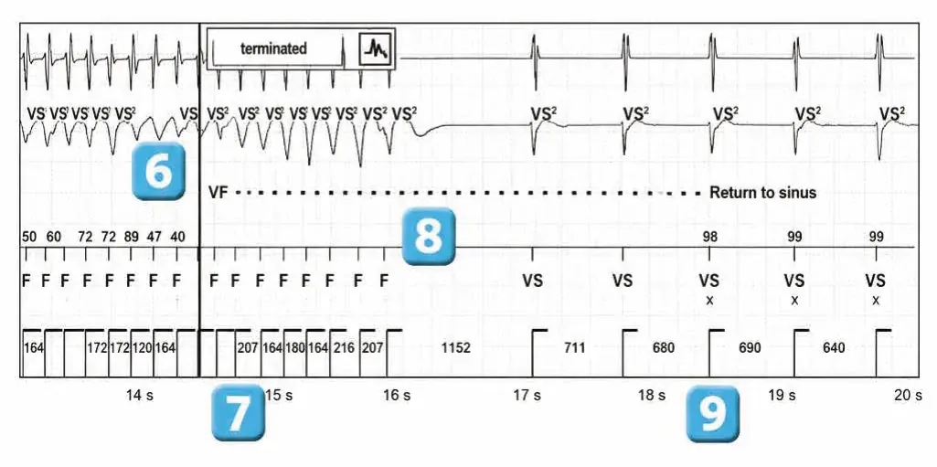 Abbott ICD electrogram, segment 3 of 3 — Classification of cycles, tachycardia counters and evolution of guideline recommendations