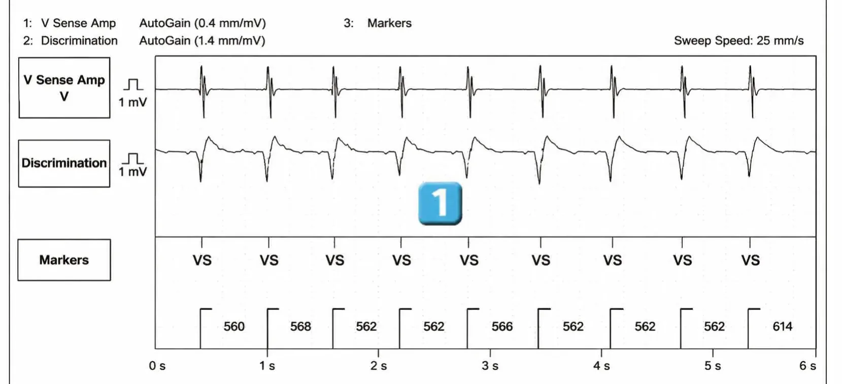 Abbott ICD electrogram, segment 1 of 3 — New recommendations and non-sustained tachycardia