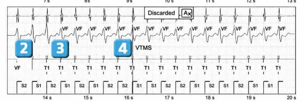 Abbott ICD electrogram, segment 2 of 3 — New recommendations and non-sustained tachycardia