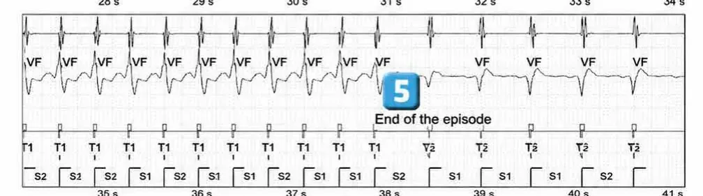 Abbott ICD electrogram, segment 3 of 3 — New recommendations and non-sustained tachycardia