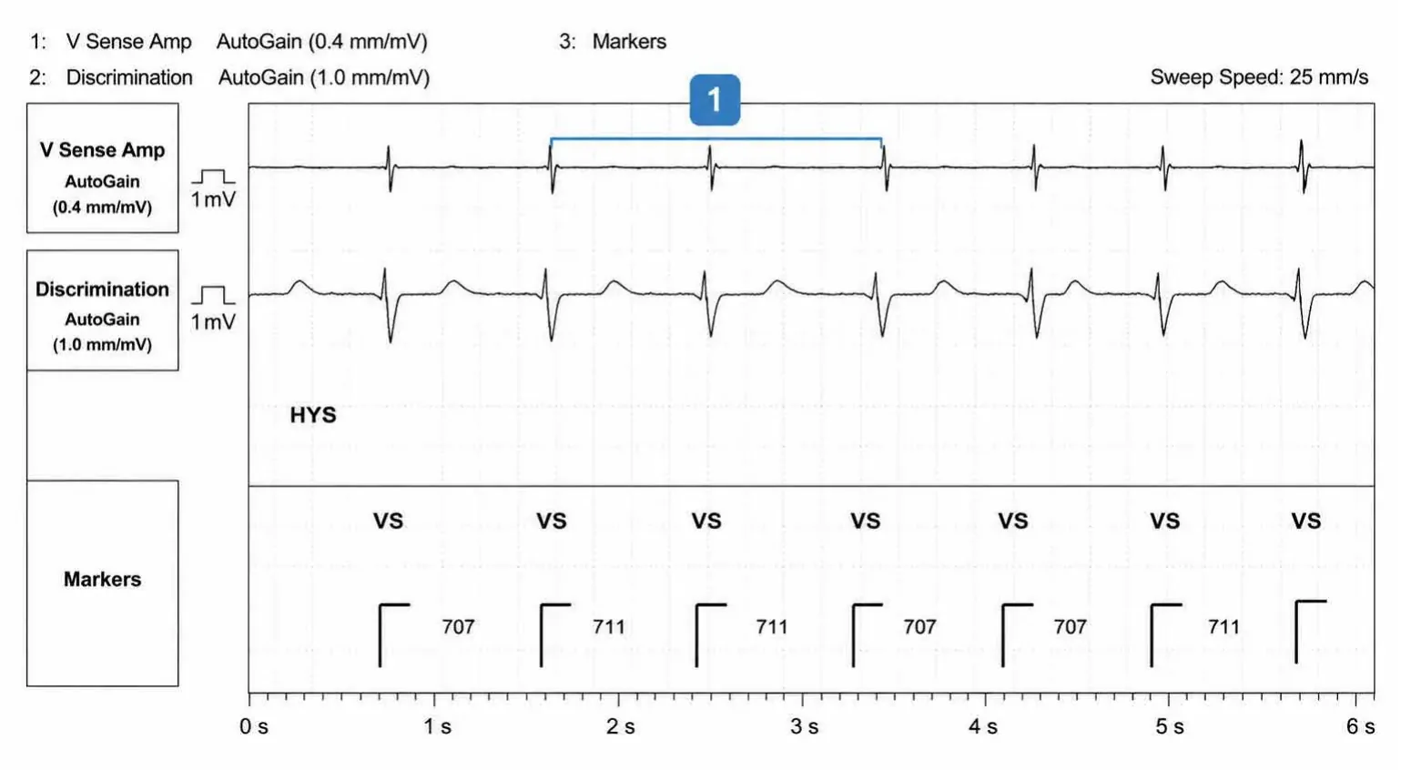Abbott ICD electrogram, segment 1 of 6 — Operating principles, specific features of the Gallant platform