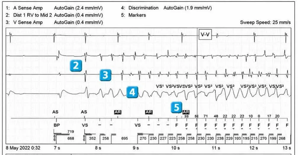 Abbott ICD electrogram, segment 2 of 6 — Operating principles, specific features of the Gallant platform