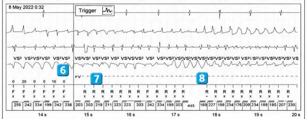 Abbott ICD electrogram, segment 3 of 6 — Operating principles, specific features of the Gallant platform