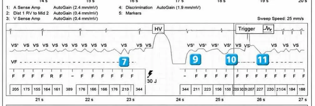 Abbott ICD electrogram, segment 4 of 6 — Operating principles, specific features of the Gallant platform
