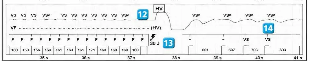 Abbott ICD electrogram, segment 5 of 6 — Operating principles, specific features of the Gallant platform