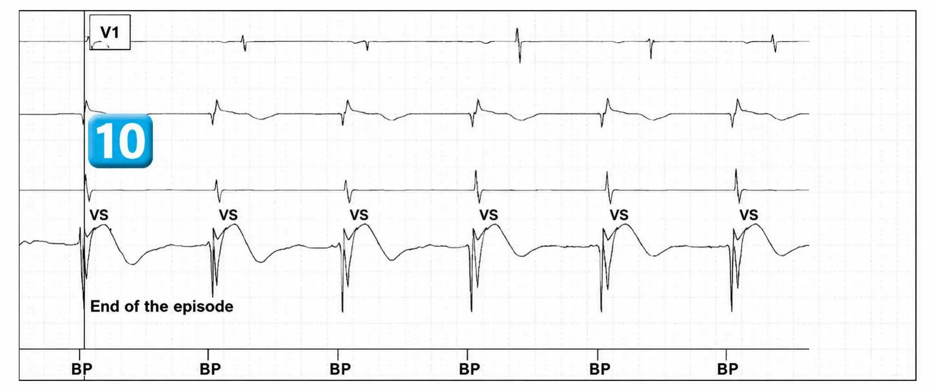 Abbott ICD electrogram, segment 6 of 6 — Operating principles, specific features of the Gallant platform