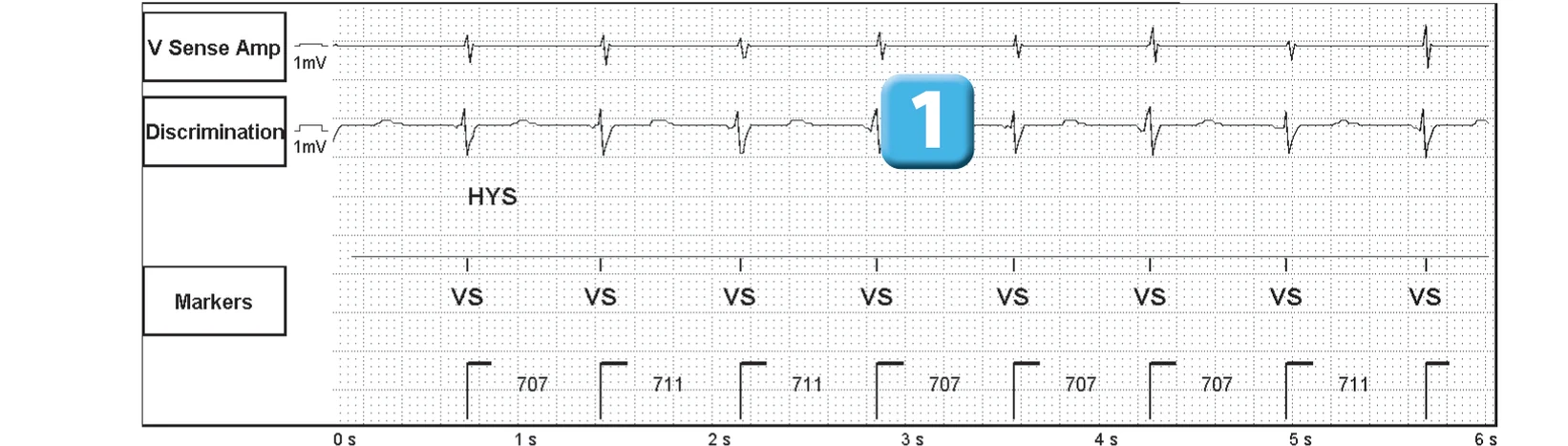 Abbott ICD electrogram, segment 1 of 6 — Operating principles, initial detection and redetection