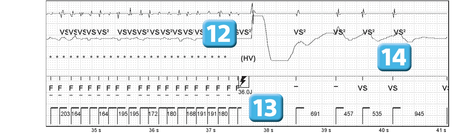 Abbott ICD electrogram, segment 6 of 6 — Operating principles, initial detection and redetection