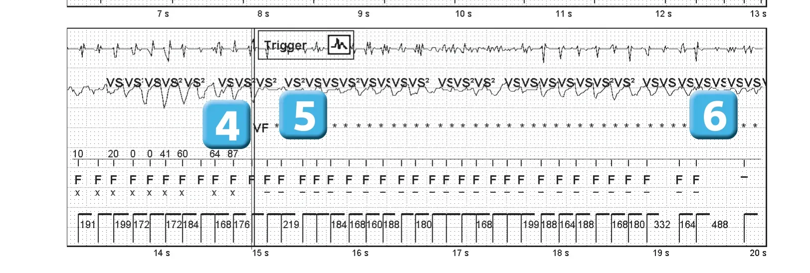 Abbott ICD electrogram, segment 2 of 4 — Operating principles, intial detection and redetection