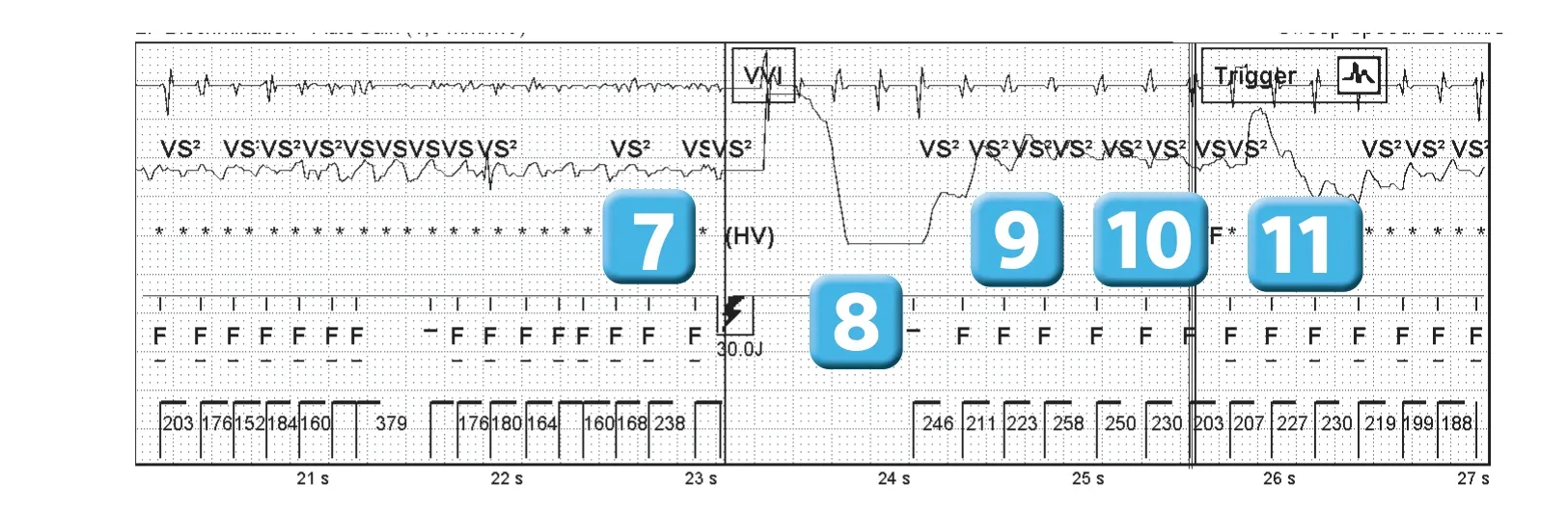 Abbott ICD electrogram, segment 3 of 4 — Operating principles, intial detection and redetection