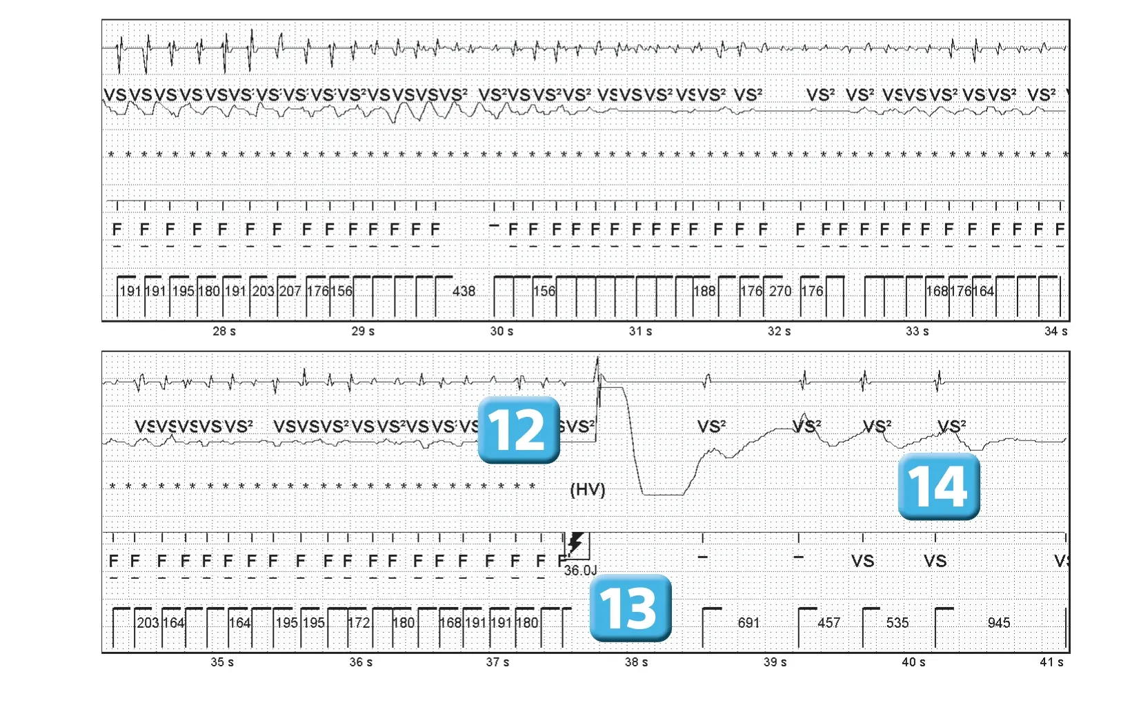Abbott ICD electrogram, segment 4 of 4 — Operating principles, intial detection and redetection