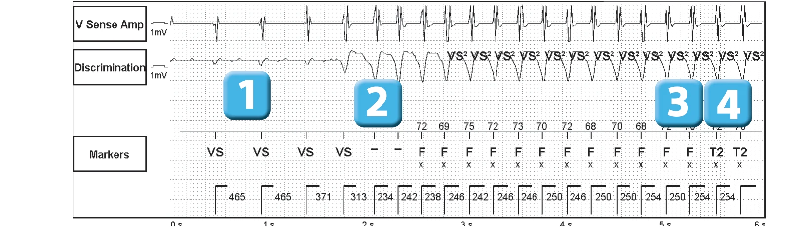 Abbott ICD electrogram, segment 1 of 3 — Competition between different detection counters