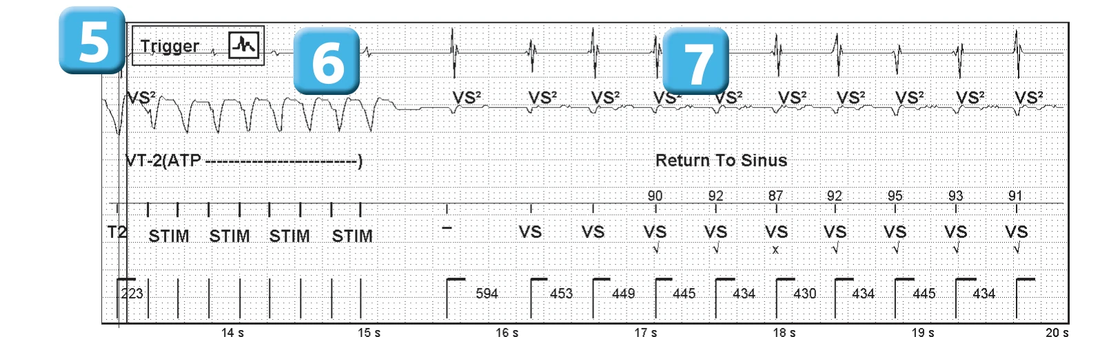 Abbott ICD electrogram, segment 3 of 3 — Competition between different detection counters