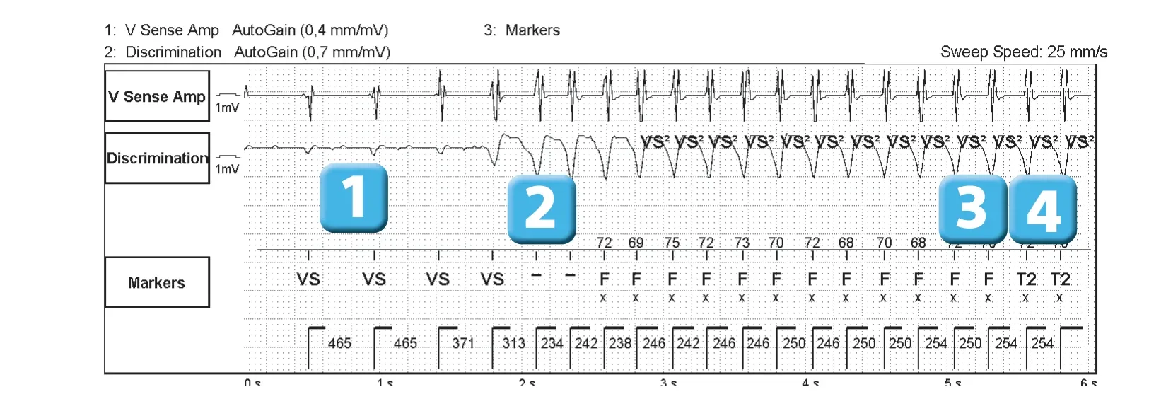 Abbott ICD electrogram, segment 1 of 2 — Competition between diffrent detection counters
