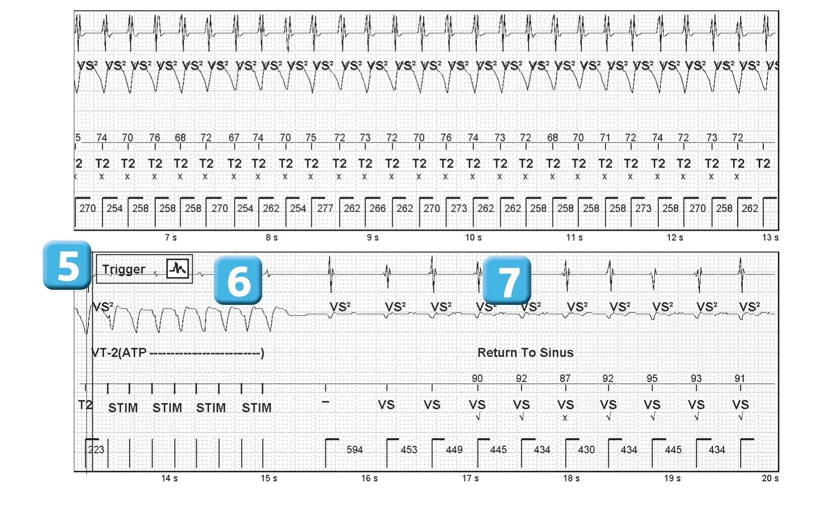 Abbott ICD electrogram, segment 2 of 2 — Competition between diffrent detection counters