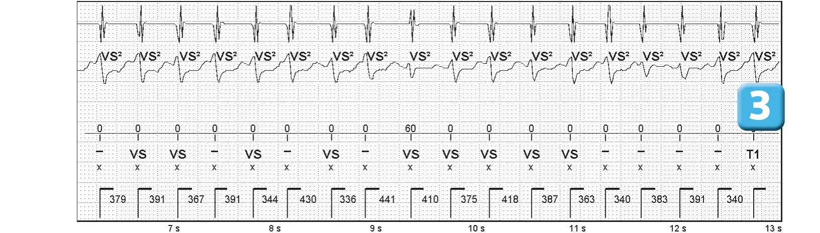 Abbott ICD electrogram, segment 2 of 5 — Competition between the different detection counters and spontaneous reduction