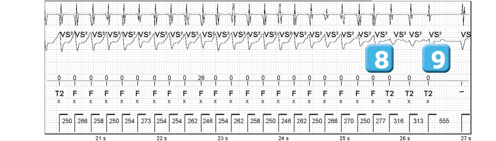 Abbott ICD electrogram, segment 4 of 5 — Competition between the different detection counters and spontaneous reduction