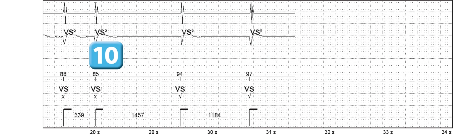 Abbott ICD electrogram, segment 5 of 5 — Competition between the different detection counters and spontaneous reduction