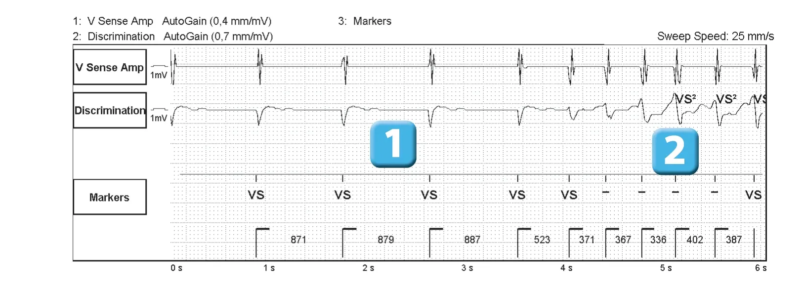 Abbott ICD electrogram, segment 1 of 3 — Competition between the different detection counters and et spontaneous reduction