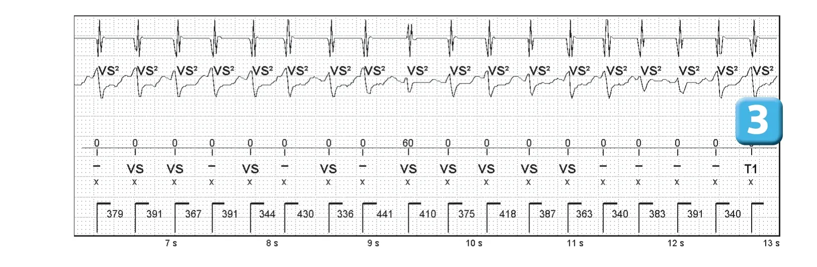 Abbott ICD electrogram, segment 2 of 3 — Competition between the different detection counters and et spontaneous reduction