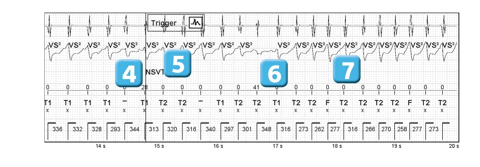 Abbott ICD electrogram, segment 3 of 3 — Competition between the different detection counters and et spontaneous reduction