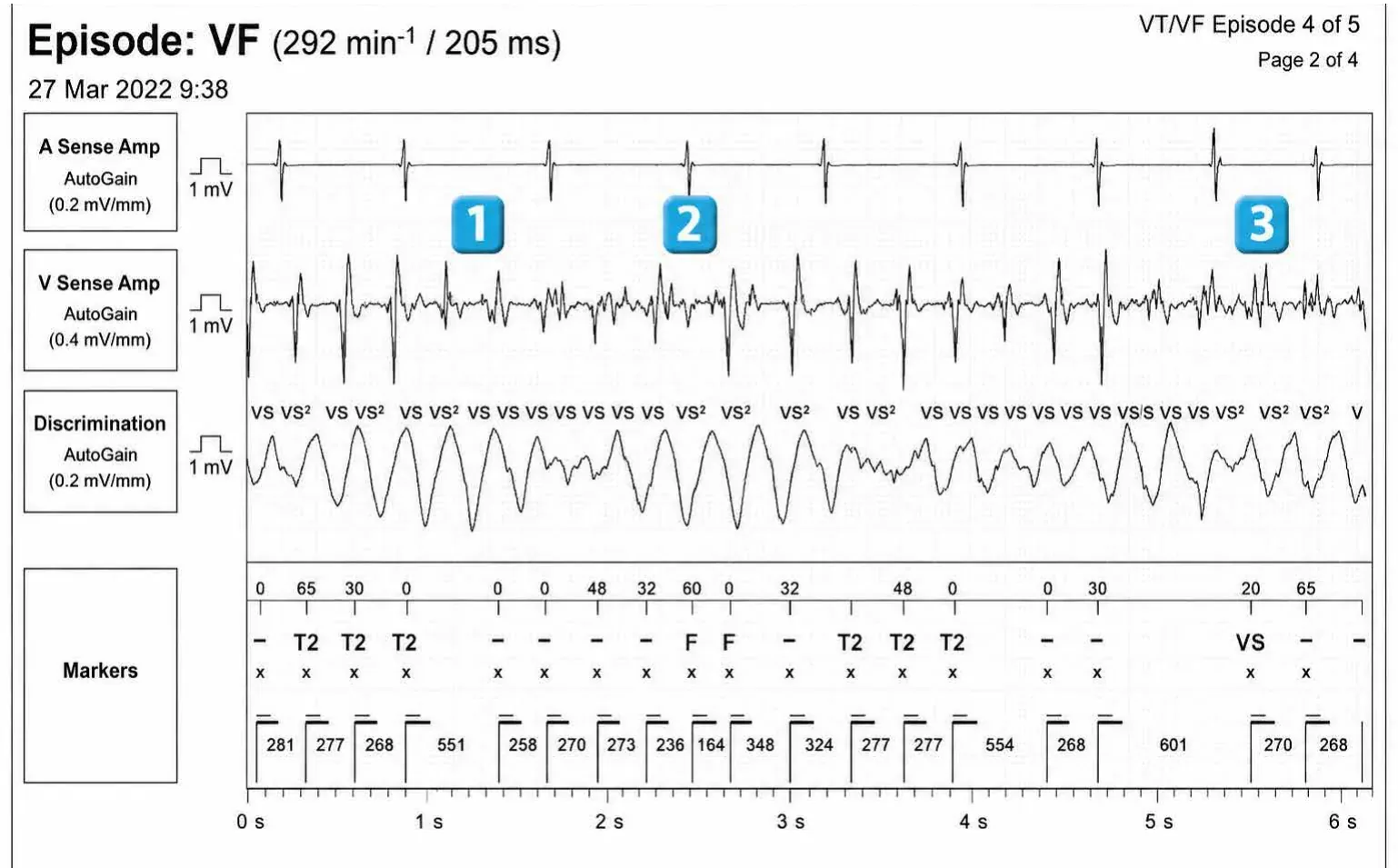Abbott ICD electrogram, segment 1 of 3 — Classification of cycles and ventricular undersensing during an episode of VF