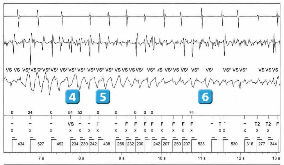 Abbott ICD electrogram, segment 2 of 3 — Classification of cycles and ventricular undersensing during an episode of VF