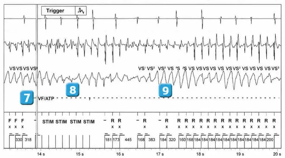 Abbott ICD electrogram, segment 3 of 3 — Classification of cycles and ventricular undersensing during an episode of VF