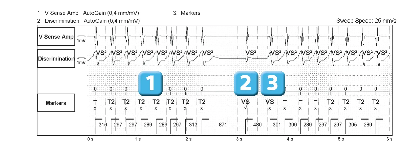 Abbott ICD electrogram, segment 1 of 2 — Sinus return counter and non-sustained ventricular tachycardias